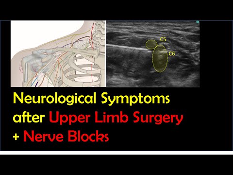 Postoperative Neurological Symptoms After Upper Limb Surgery & Nerve Blocks