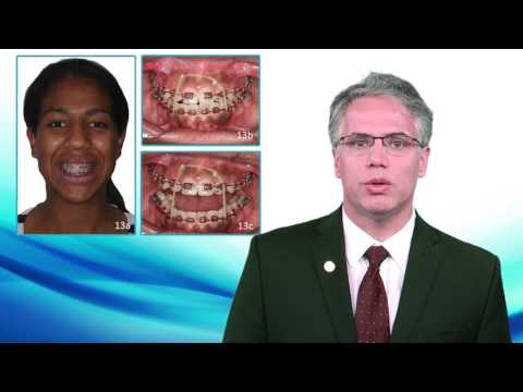 Nonsurgical treatment of severe Class II malocclusion with anterior open bite using mini-implants