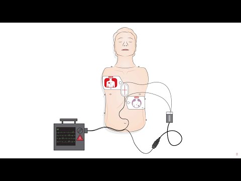Using Shocklink with Zoll X series or Zoll AED Plus and Laerdal Link Manikins