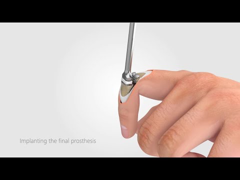 CapFlex PIP – Endoprosthetic treatment of proximal interphalangeal joint (dorsal approach)