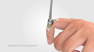 CapFlex PIP – Endoprothetische Versorgung des proximalen Interphalangealgelenks (dorsaler Zugang)