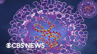 Health officials investigating possible monkeypox case in New York City