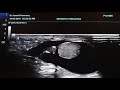 Bell Clapper Deformity Sonography