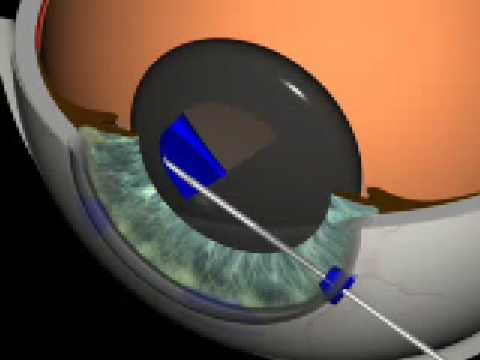 Cataract Surgery 3D Animation (O. Findl, MD, Vienna)