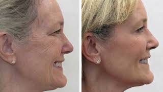 Ohm Med Spa San Diego: Botox Treatment, Microneedling, Dermal Fillers 