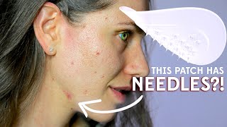 What Happened To This Pimple In 24 Hours - ZitSticka Killa Patch & Microdart Test