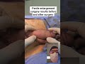 Penile Enlargement Surgery Results Before And After Surgery Andrologist Shorts Penileenlargement