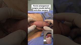 Download lagu Penile enlargement surgery results before and after surgery #andrologist #shorts #penileenlargement mp3 Download lagu Penile enlargement surgery results before and after surgery #andrologist #shorts #penileenlargement mp3