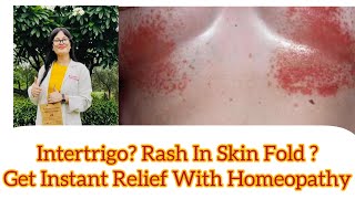 Rash In Skin Fold ? Intertrigo? Best Homeopathic Medicine For groin rash ? Toe rash ? Breast Rash