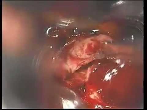 Trans-Sphenoidal Operation of the Pituitary Tumor