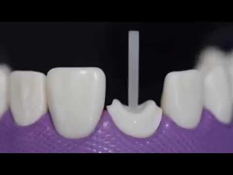 POST CORE BUILD UP OF BADLY BROKEN DOWN TOOTH