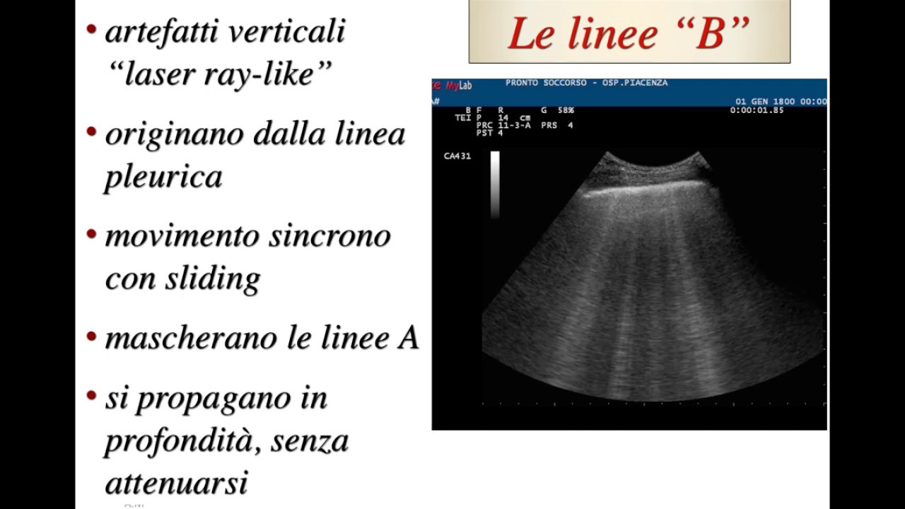 Watch Now 5 Sindrome Interstiziale 5 Sindrome Interstiziale