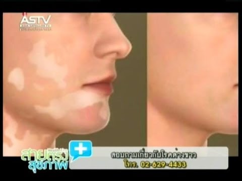 ไม่ ihtiolovaya ครีมสำหรับโรคสะเก็ดเงิน โรคสะเก็ดเงินทั้งร่างกายกว่าการรักษา