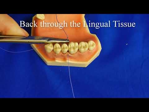 Figure of Eight Suture