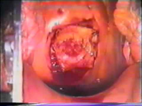 Lato sinistro scoliosi toracica della fotografia colonna vertebrale Ricetta da giunti con denti di leone