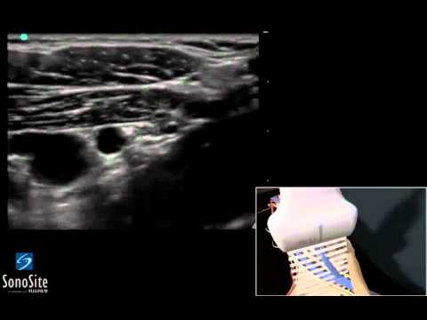 Spalla dolore articolare dopo lintervento chirurgico Esempi cyclarthrosis articolazioni