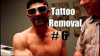 Tattoo Removal Session #6 | How to Remove a Dumb Tattoo
