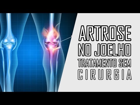 KNEE ARTHROSIS - Treatment without surgery