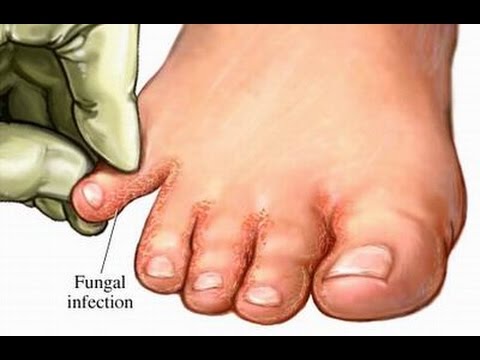 Kung paano ituring ang mga kuko mula sa pinsala sa katawan Mga gamot sa pag-inom mula sa isang halamang-singaw