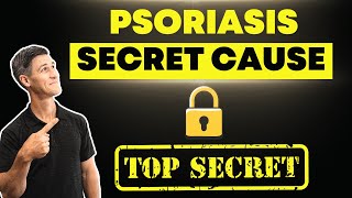 The Secret Cause of Psoriasis | Must Know to get Rid of Psoriasis
