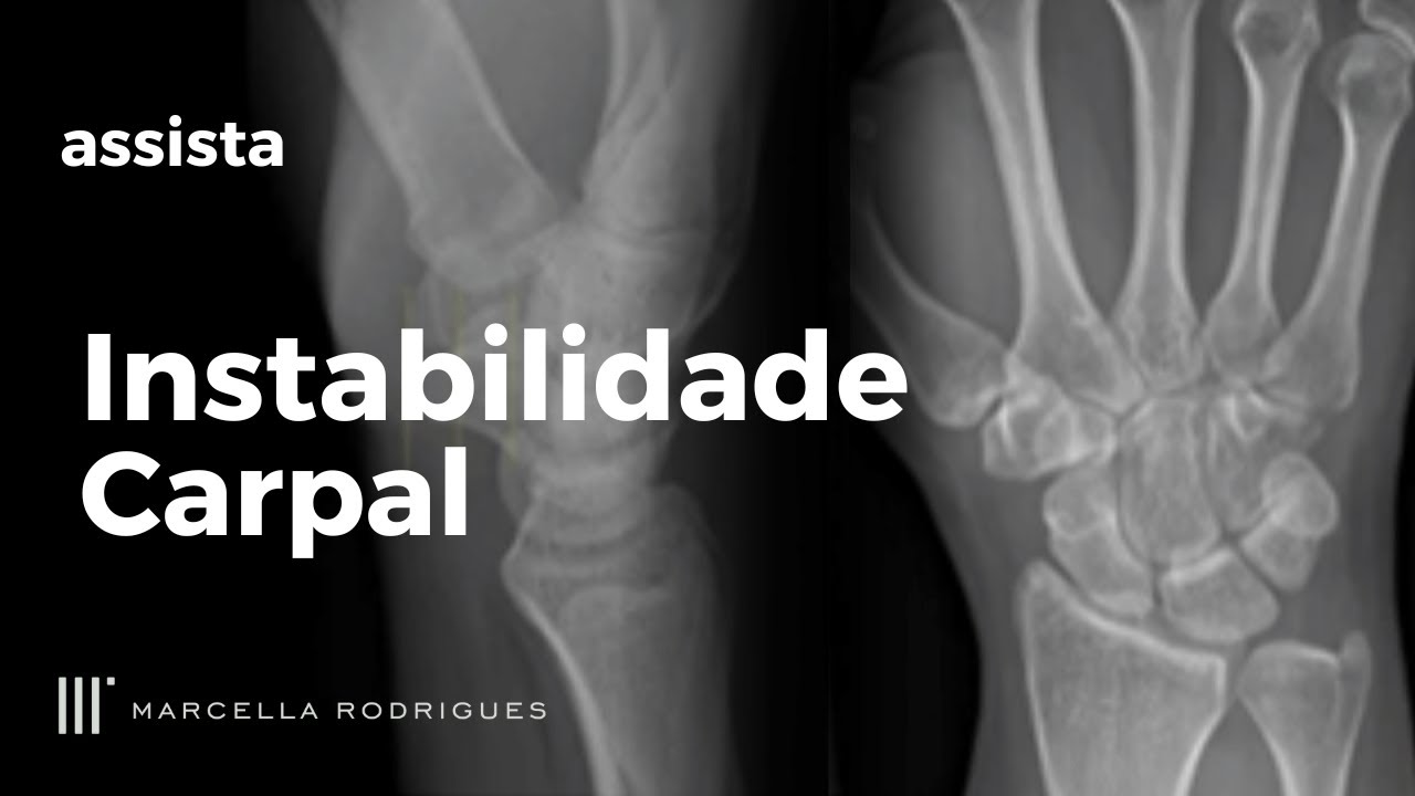 INSTABILIDADE CARPAL: Aprenda a Diagnosticar e Tratar