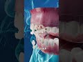Opening Bottles With Your Teeth
