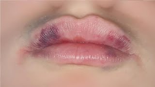 how to get rid of bruises on your lips fast tutorial