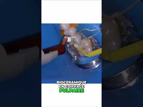 Coiffage pulpaire direct avec Well-root – Endodontie