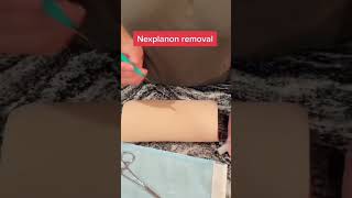 Nexplanon removal #obgyn #womenshealth #birthcontrol #nexplanon