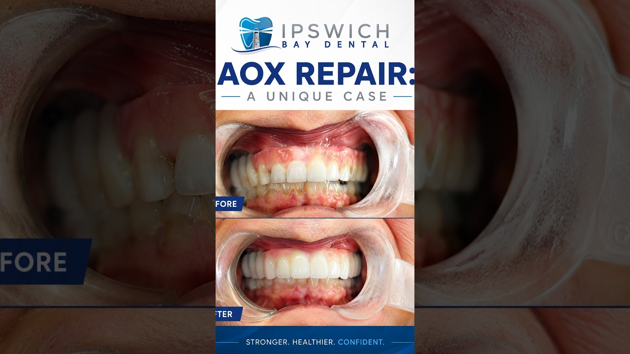 Emergency front tooth implant clinical case video thumbnail
