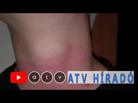 Láb psoriasis krém