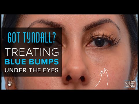 Got Tyndall? Treating Blue Bumps under the Eyes after Filler Injections