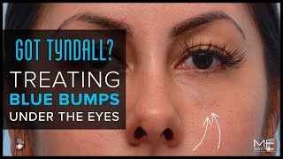 Got Tyndall? Treating Blue Bumps under the Eyes after Filler Injections