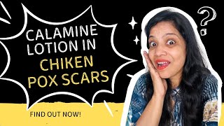 Does Calamine lotion Treat Chicken Pox Scars? - Quick Resolution