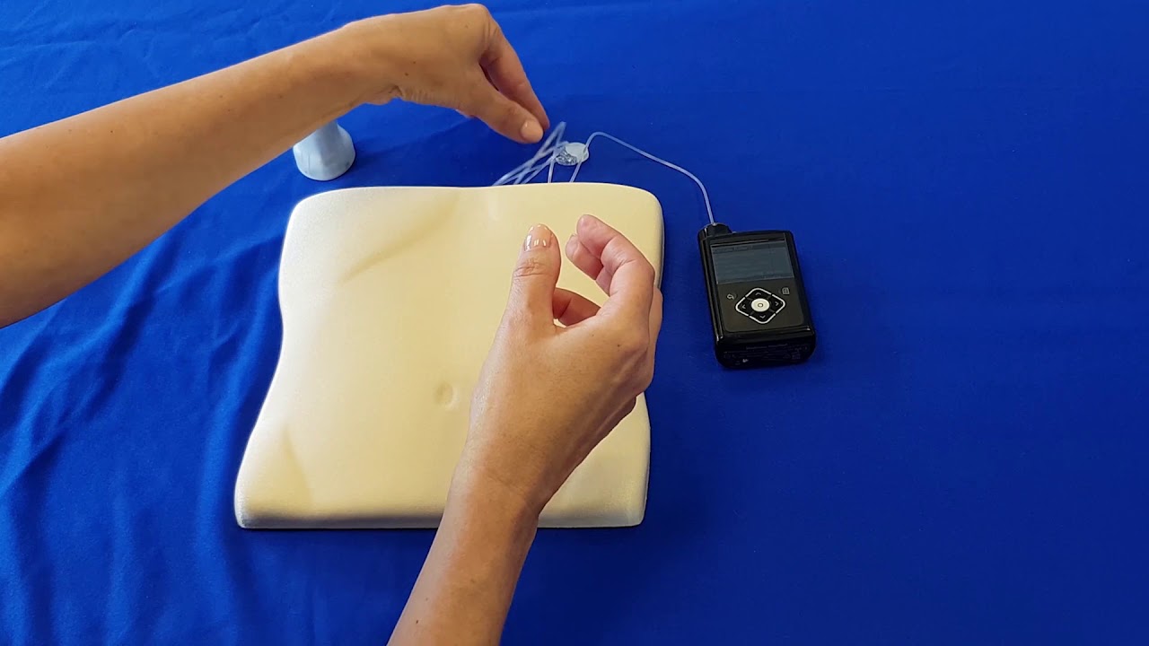 Hoe is de Medtronic MiniMed Mio Advance-infusieset in te brengen?
Belangrijkste functies
90° zachte Teflon-canule.
Geladen inbrengapparaat.
Verborgen naald voor en na gebruik.
Kan worden gebruikt met Medtronic-pompen en elke niet-Medtronic-pomp met een luer-lock-aansluiting.
Hoorbare "klik" garandeert een veilige aansluiting.