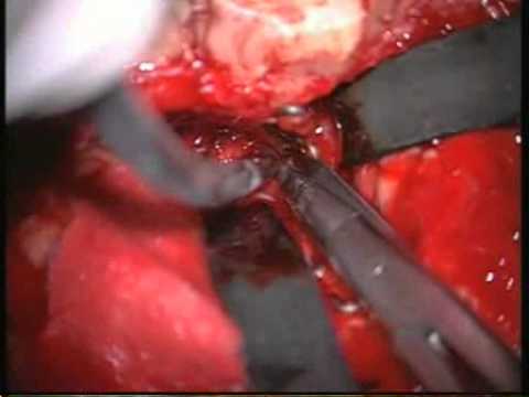 petroclival meningioma 1st stage : transsinus posterior  and middle fossa approach