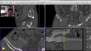 3D Curved MPR Básico