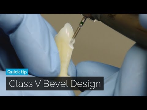 Class V Composite Bevel Design | DOTHANDSON