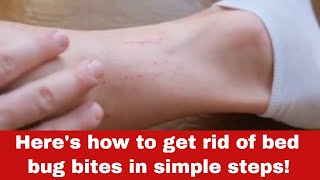 How to Get Rid of Bed Bug Bites [Detailed Guide]