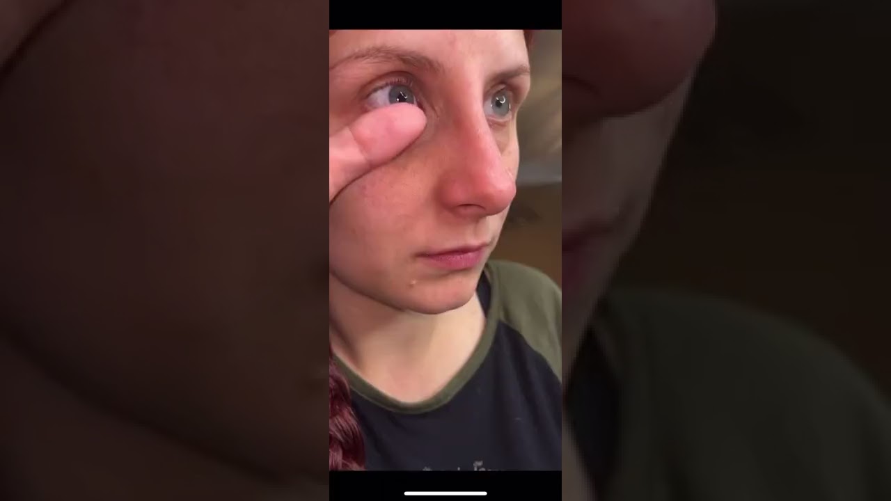 DMV Versa Scleral Lens Removal/Insertion Tool