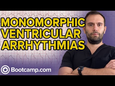 Monomorphic Ventricular Tachycardia | HIGH-YIELD CARDIOLOGY | USMLE STEP 1