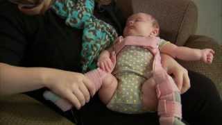 Baby Hip Instability and Dysplasia - Mayo Clinic