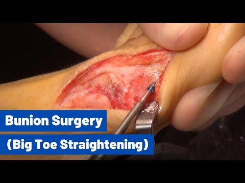 Cosmetic Toe Shortening Long Toe Surgery Video Without Metal Pins
