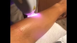 Laser Hair Removal is Affordable at VIP Health and Laser Clinic