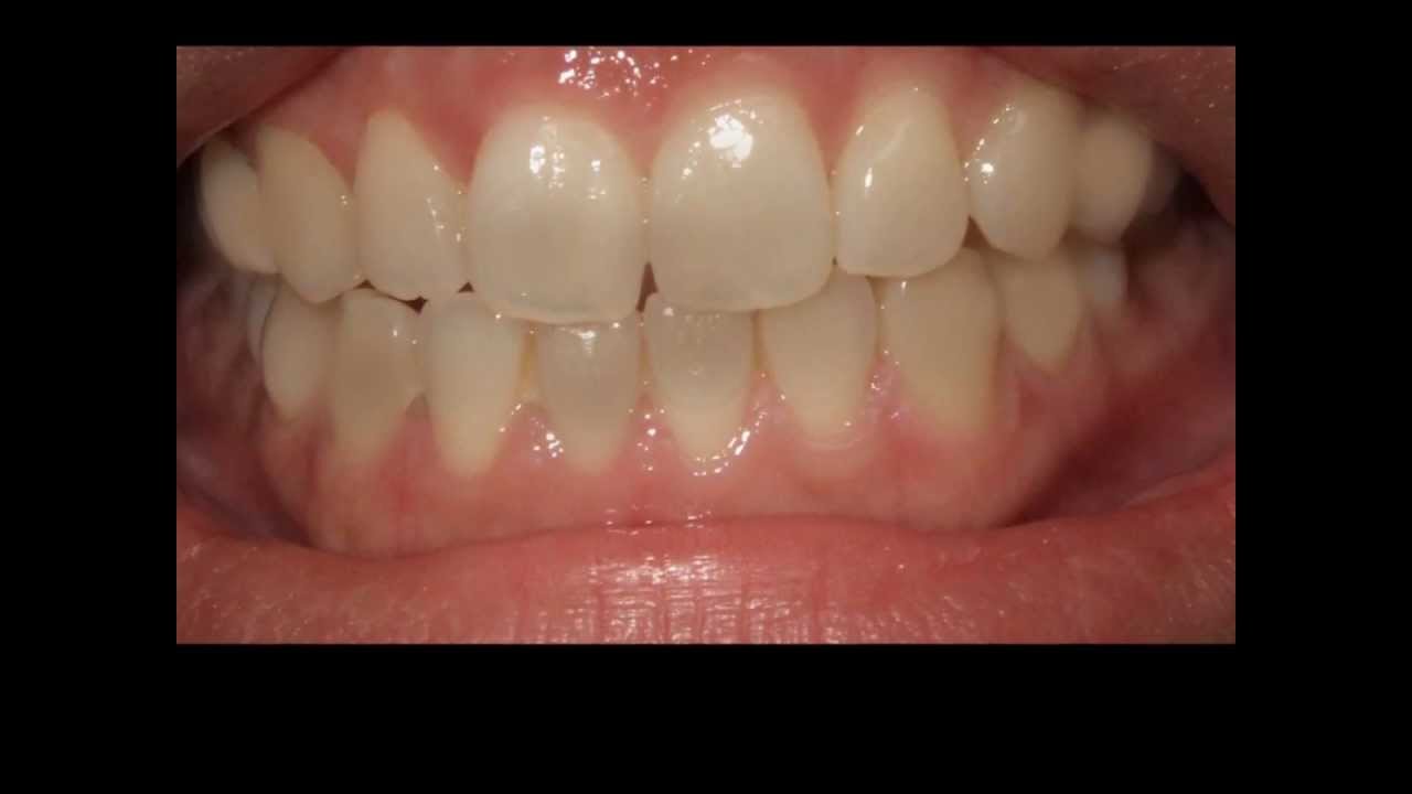 Blanchiment des dents au cabinet de la Renaissance Paris 8