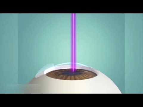 Lasik et PresbyLasik - Opération laser des yeux - Myopie, astigmatisme, hypermétropie et presbytie