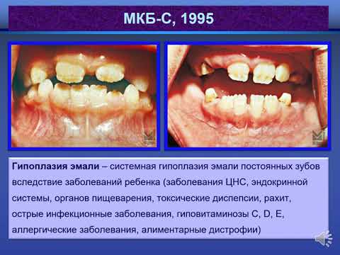 Некариозные поражения твёрдых тканей зубов, возникающие в период фолликулярного развития. Этиология, патогенез, клинические проявления, диагностика, возможности лечения