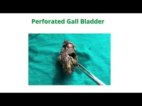 Gall Bladder Surgery - Dr. Chetan Mhaske