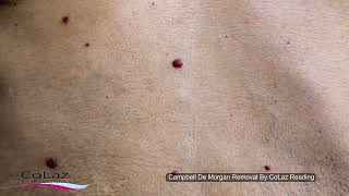 Blood Spots Removal (Campbell De Morgan Spots / Cherry Angioma )