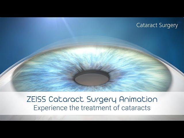 Cataract Extraction at Specialist and Test Winner EuroEyes